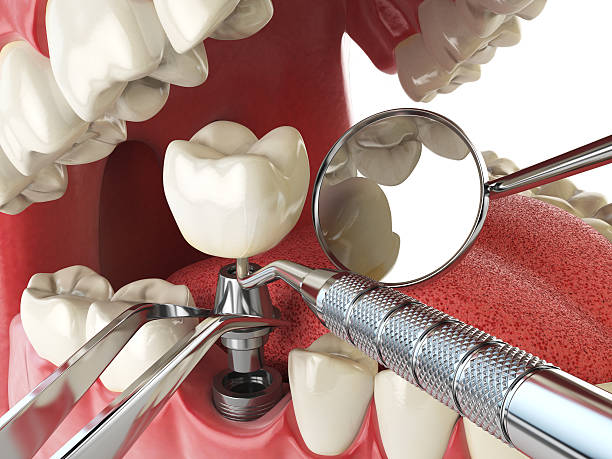 Best Emergency Tooth Extraction in Bannockburn, IL